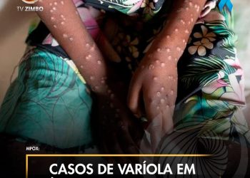 Casos de “Varíola” em África preocupa OMS