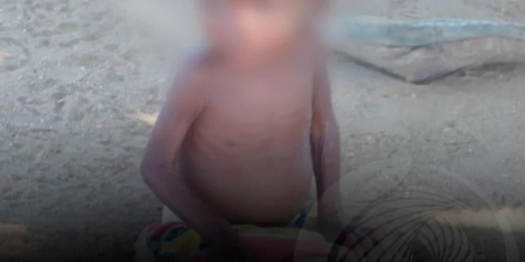 Benguela regista 139 mortes por desnutrição em 2024